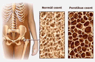 Csontritkulás nyaki kenőcsök kezelésre, A sarok ízülete fáj, hogy mit kell tenni