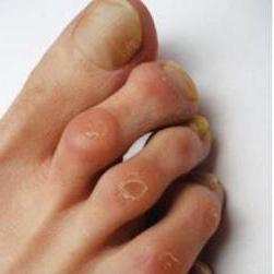 Bőrkeményedés a lábujjak között kezelés