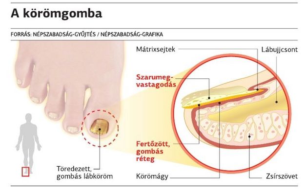 nail gombák emberek kezelése mi tabletta kezeli a gomba a köröm