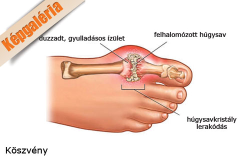a nagy lábujj gyulladt ízületének kezelése)