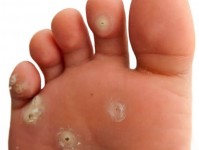 láb bőrbetegségek
