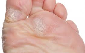 a láb bőr betegségei