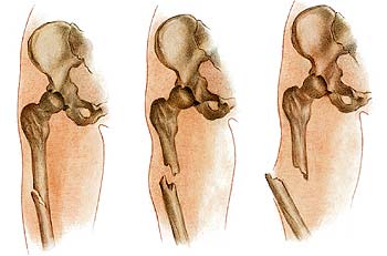 rheumatoid ízületi fájdalom a térdízület artrózisa 1 fok