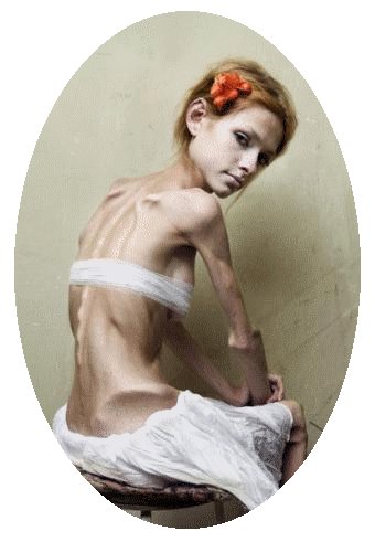 bulimia-anorexia